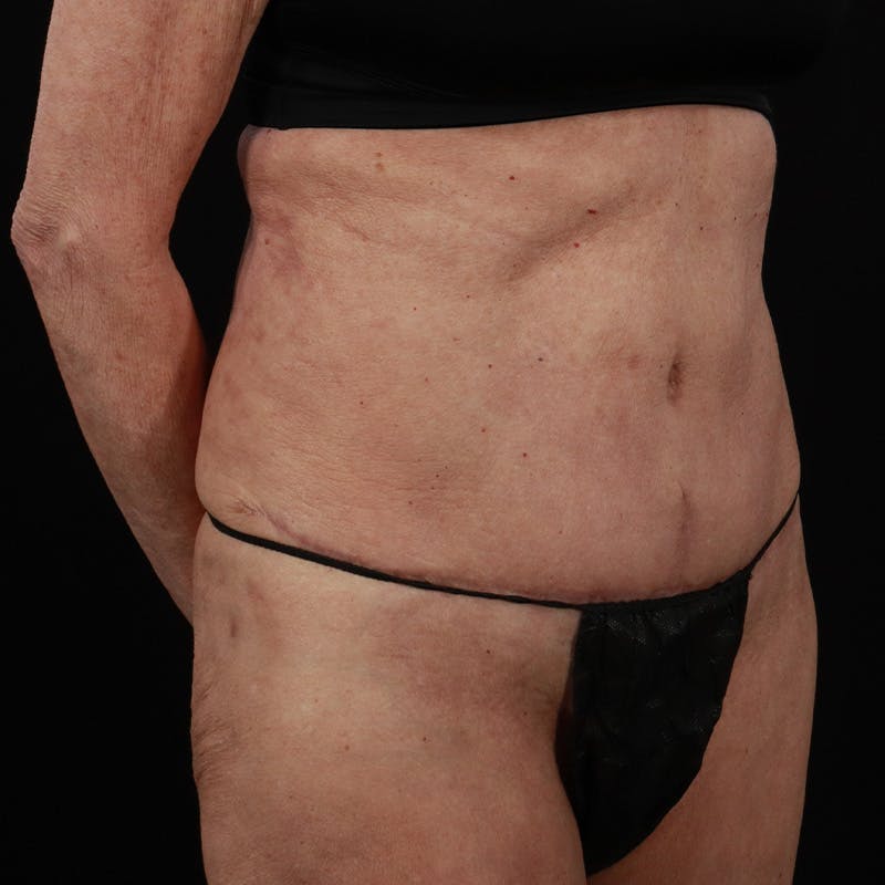 Abdominoplasty (Tummy Tuck) Before & After Gallery - Patient 397260 - Image 4