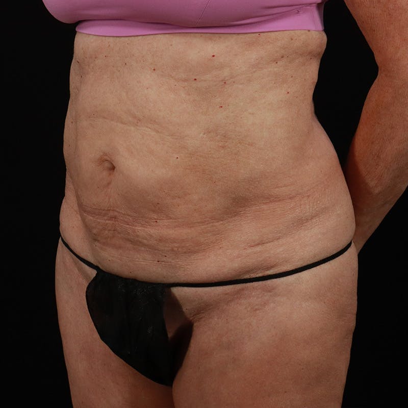 Abdominoplasty (Tummy Tuck) Before & After Gallery - Patient 397260 - Image 5
