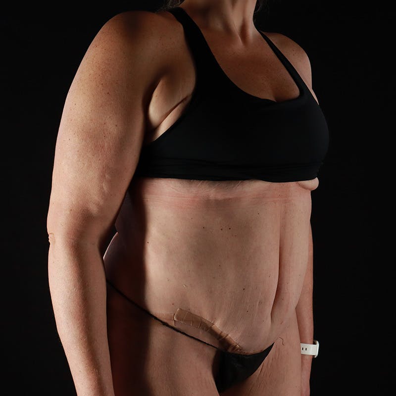 Abdominoplasty (Tummy Tuck) Before & After Gallery - Patient 253050 - Image 4