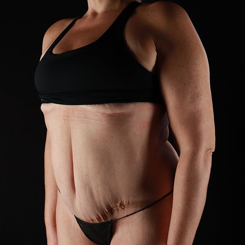 Abdominoplasty (Tummy Tuck) Before & After Gallery - Patient 253050 - Image 6