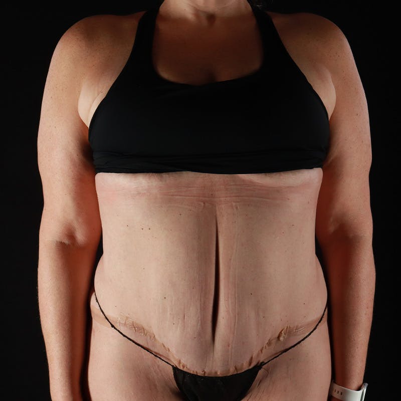Abdominoplasty (Tummy Tuck) Before & After Gallery - Patient 253050 - Image 2