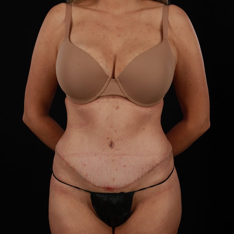 Abdominoplasty (Tummy Tuck) Before & After Gallery - Patient 355011 - Image 2