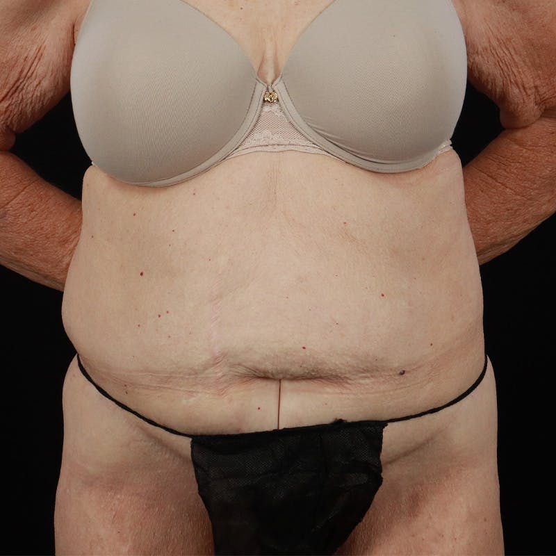 Abdominoplasty (Tummy Tuck) Before & After Gallery - Patient 265927 - Image 1