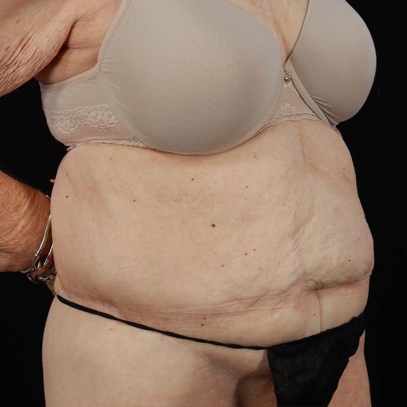 Abdominoplasty (Tummy Tuck) Before & After Gallery - Patient 265927 - Image 3