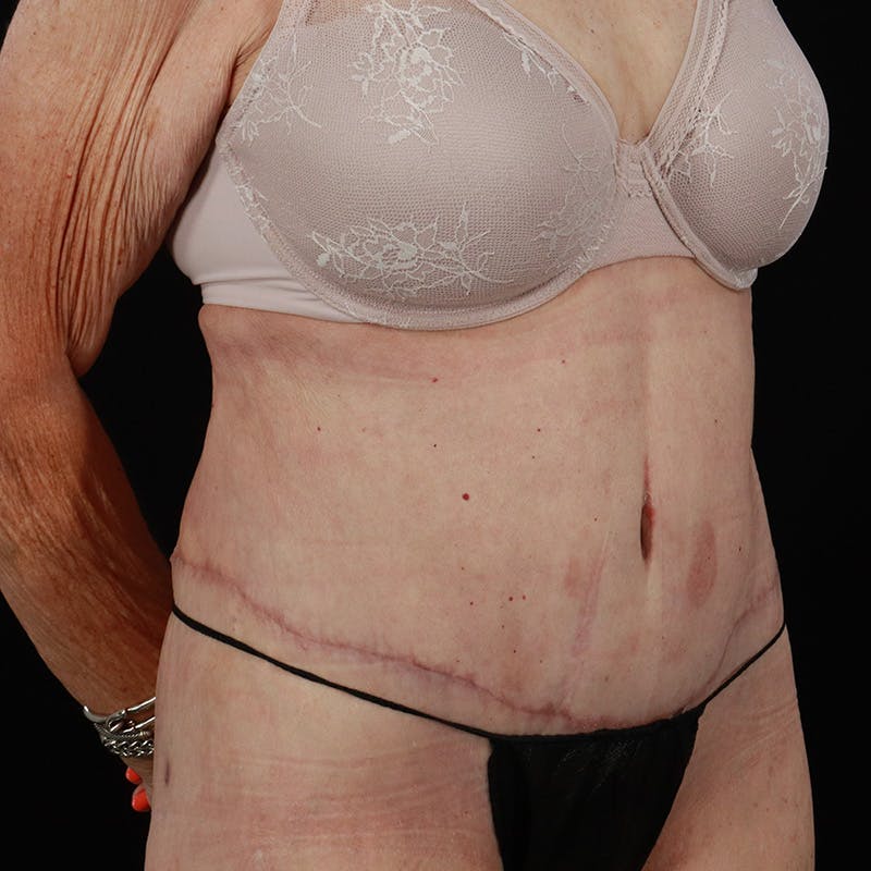 Abdominoplasty (Tummy Tuck) Before & After Gallery - Patient 265927 - Image 4