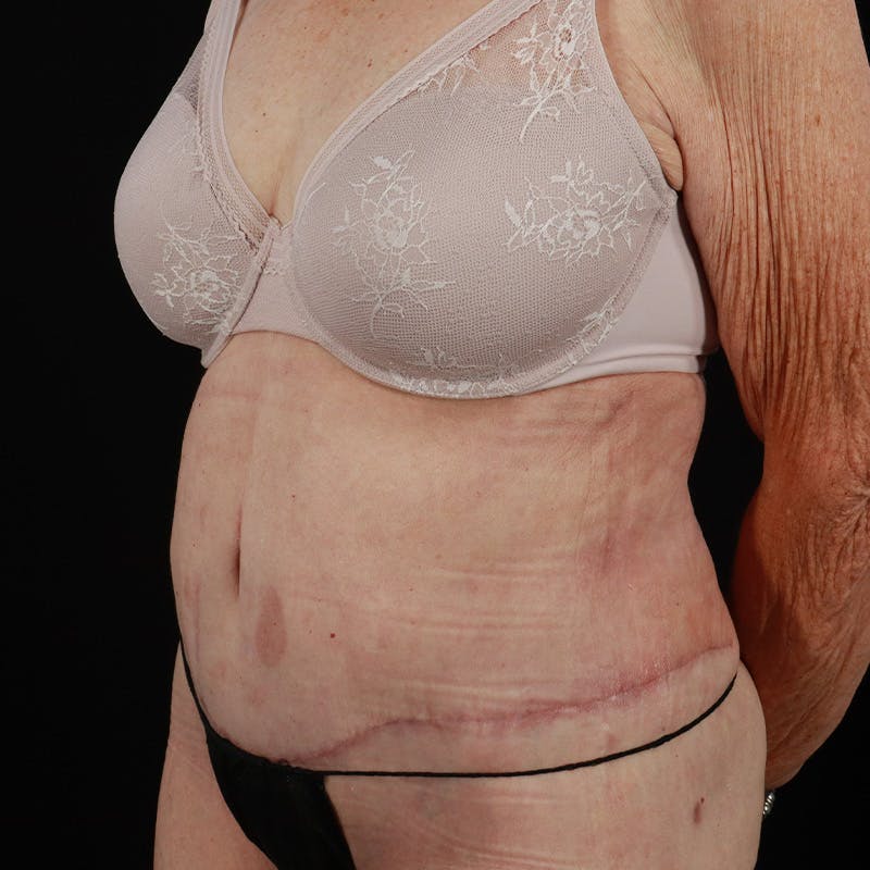 Abdominoplasty (Tummy Tuck) Before & After Gallery - Patient 265927 - Image 6