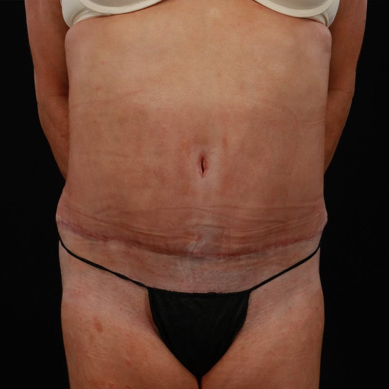 Abdominoplasty (Tummy Tuck) Before & After Gallery - Patient 255996 - Image 2