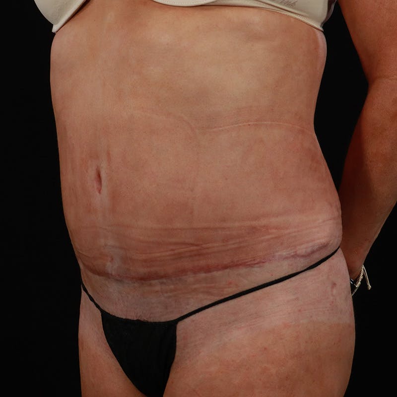 Abdominoplasty (Tummy Tuck) Before & After Gallery - Patient 255996 - Image 6
