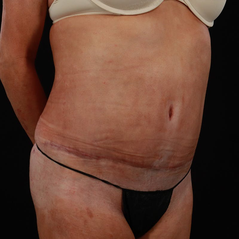 Abdominoplasty (Tummy Tuck) Before & After Gallery - Patient 255996 - Image 4