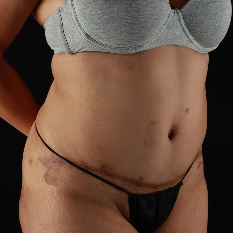 Abdominoplasty (Tummy Tuck) Before & After Gallery - Patient 363215 - Image 4