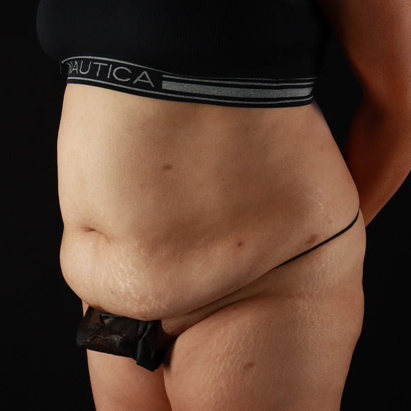 Abdominoplasty (Tummy Tuck) Before & After Gallery - Patient 363215 - Image 5