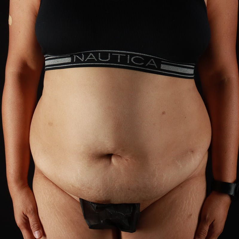 Abdominoplasty (Tummy Tuck) Before & After Gallery - Patient 363215 - Image 1