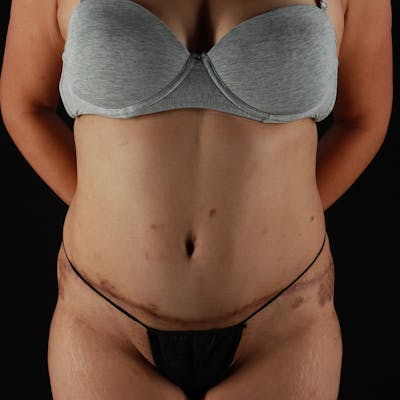 Abdominoplasty (Tummy Tuck) Before & After Gallery - Patient 363215 - Image 2