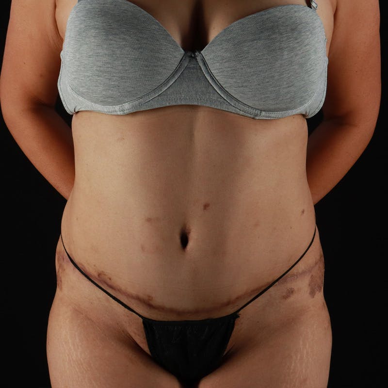 Abdominoplasty (Tummy Tuck) Before & After Gallery - Patient 363215 - Image 2
