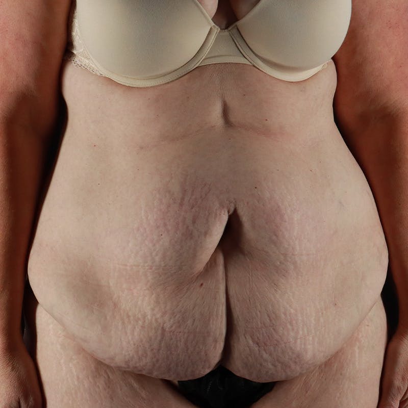 Abdominoplasty (Tummy Tuck) Before & After Gallery - Patient 133455 - Image 1