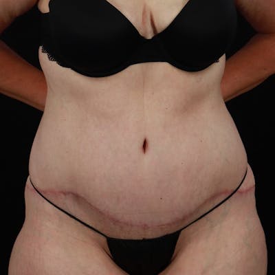Abdominoplasty (Tummy Tuck) Before & After Gallery - Patient 133455 - Image 2