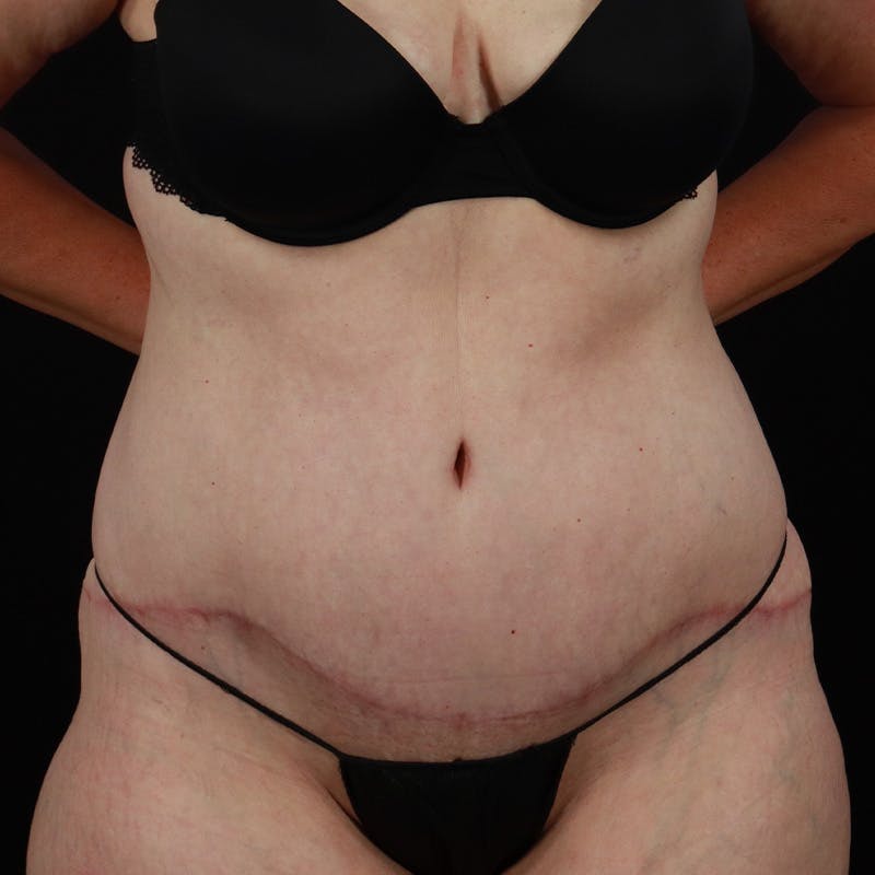 Abdominoplasty (Tummy Tuck) Before & After Gallery - Patient 133455 - Image 2