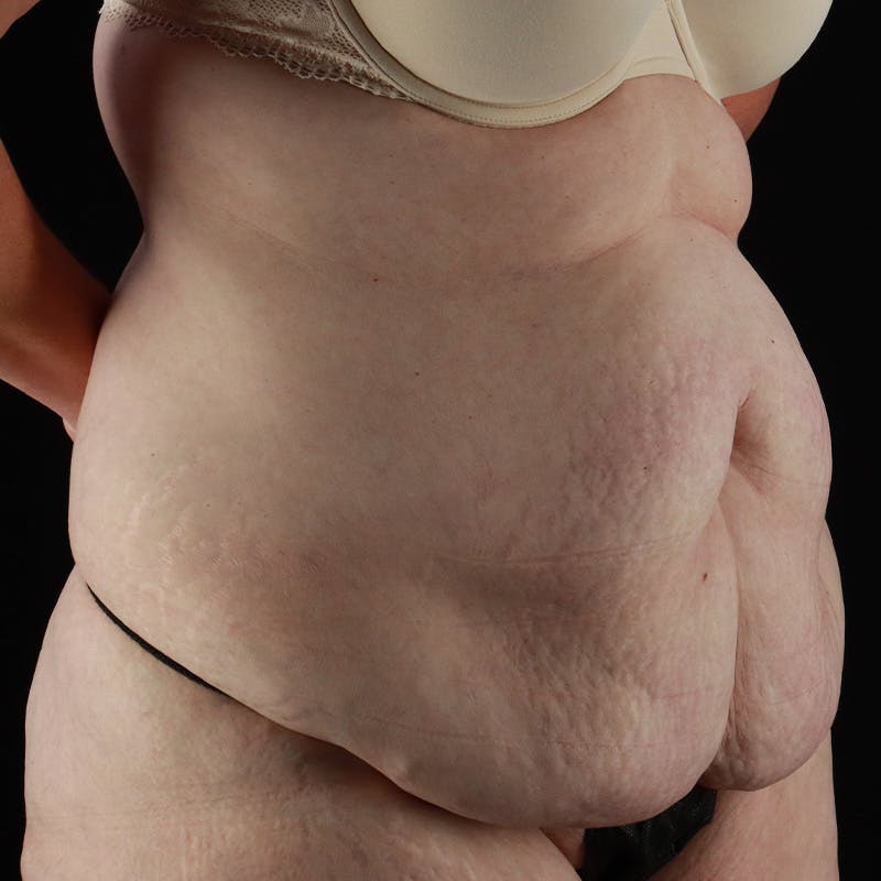 Abdominoplasty (Tummy Tuck) Before & After Gallery - Patient 133455 - Image 3