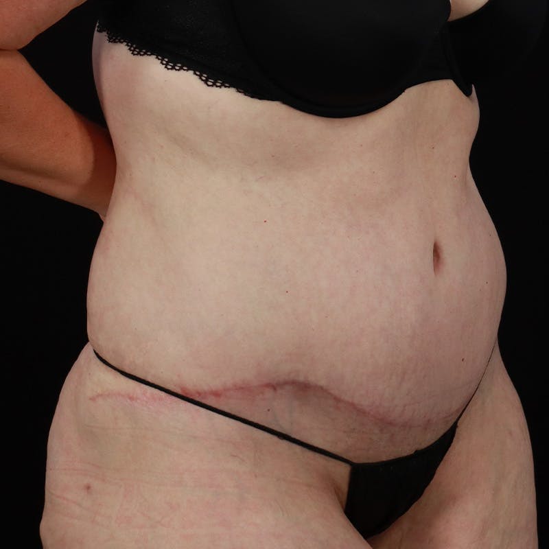 Abdominoplasty (Tummy Tuck) Before & After Gallery - Patient 133455 - Image 4