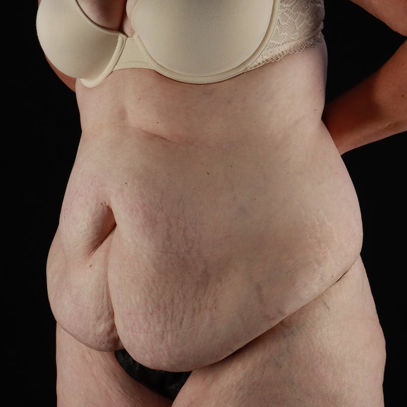 Abdominoplasty (Tummy Tuck) Before & After Gallery - Patient 133455 - Image 5