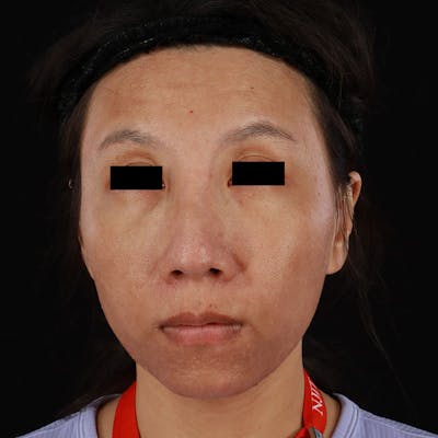 PRP/PRF Therapy Before & After Gallery - Patient 185774 - Image 1