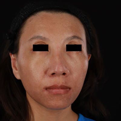 PRP/PRF Therapy Before & After Gallery - Patient 185774 - Image 2