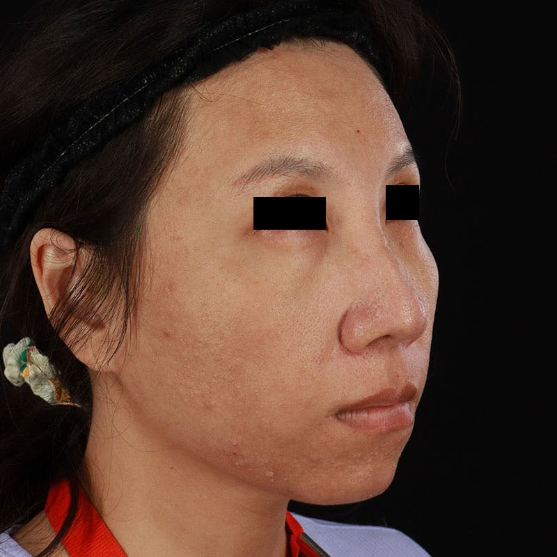 PRP/PRF Therapy Before & After Gallery - Patient 185774 - Image 3