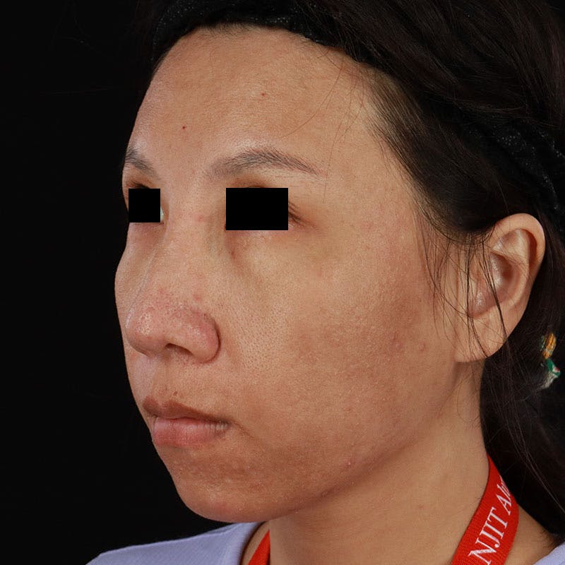 PRP/PRF Therapy Before & After Gallery - Patient 185774 - Image 5