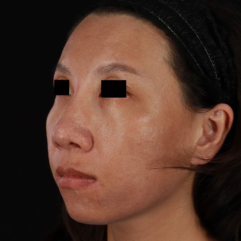 PRP/PRF Therapy Before & After Gallery - Patient 185774 - Image 6