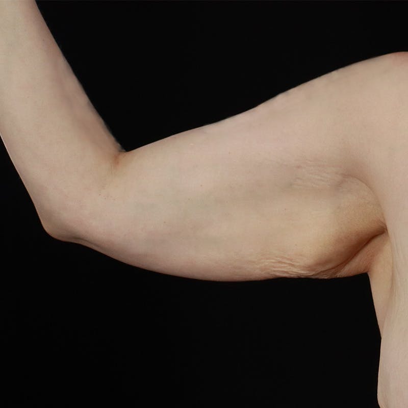 Arm Lift Before & After Gallery - Patient 101500 - Image 1