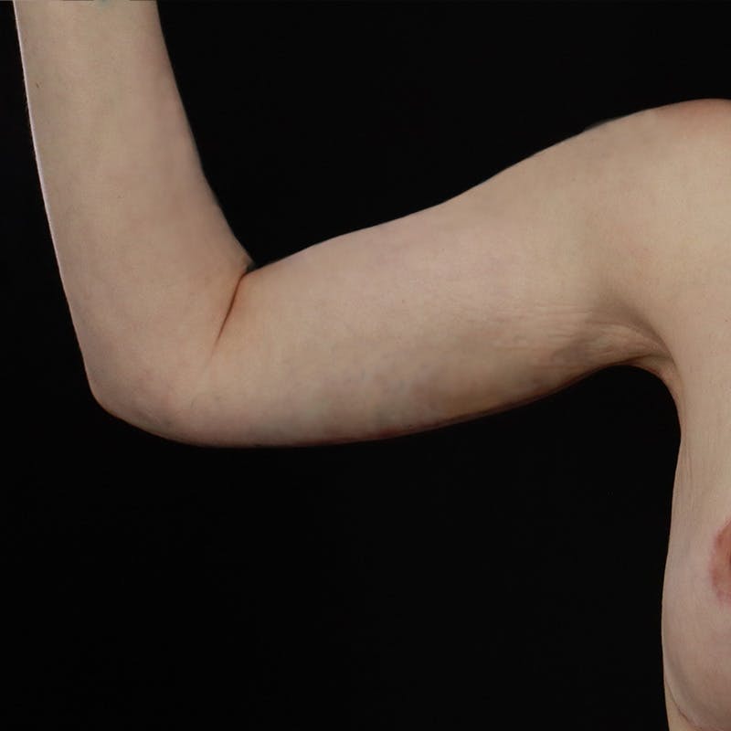 Arm Lift Before & After Gallery - Patient 101500 - Image 2