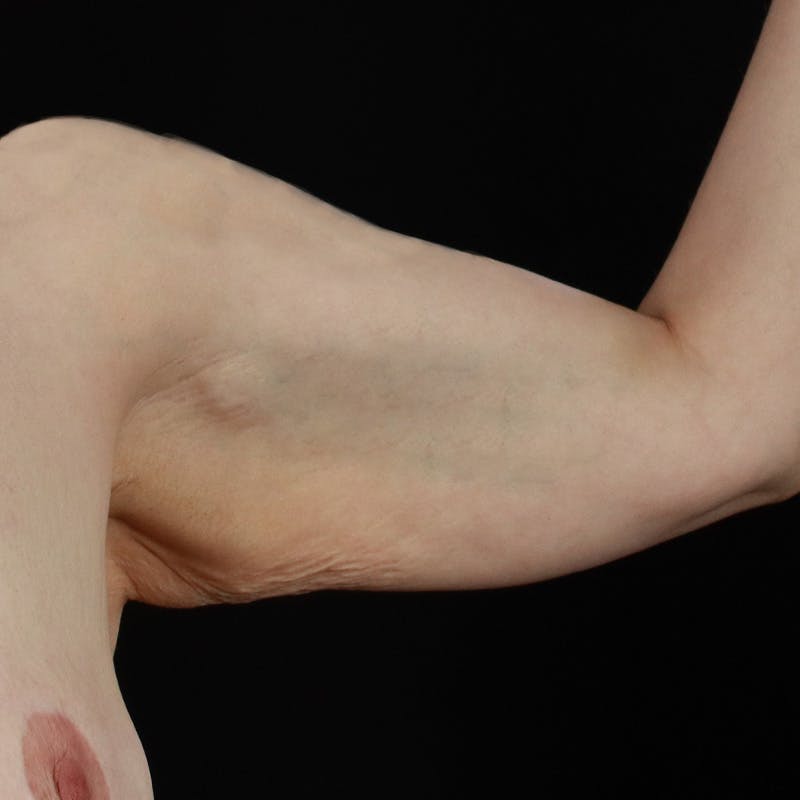 Arm Lift Before & After Gallery - Patient 101500 - Image 5