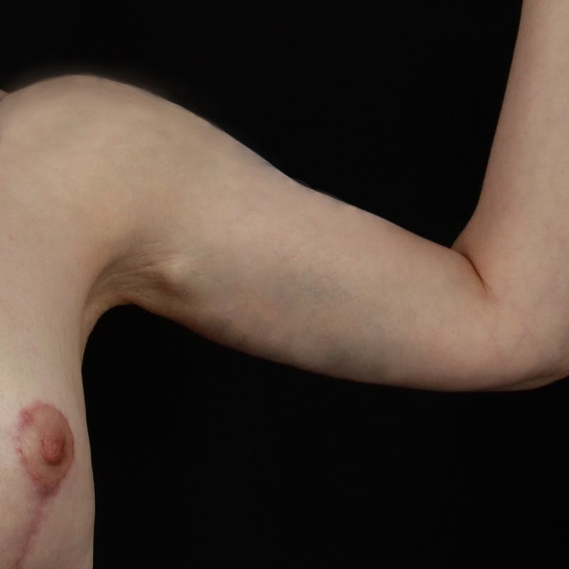 Arm Lift Before & After Gallery - Patient 101500 - Image 6