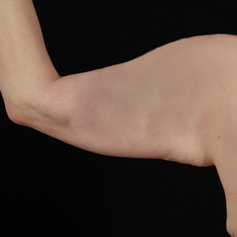 Arm Lift Before & After Gallery - Patient 101500 - Image 3