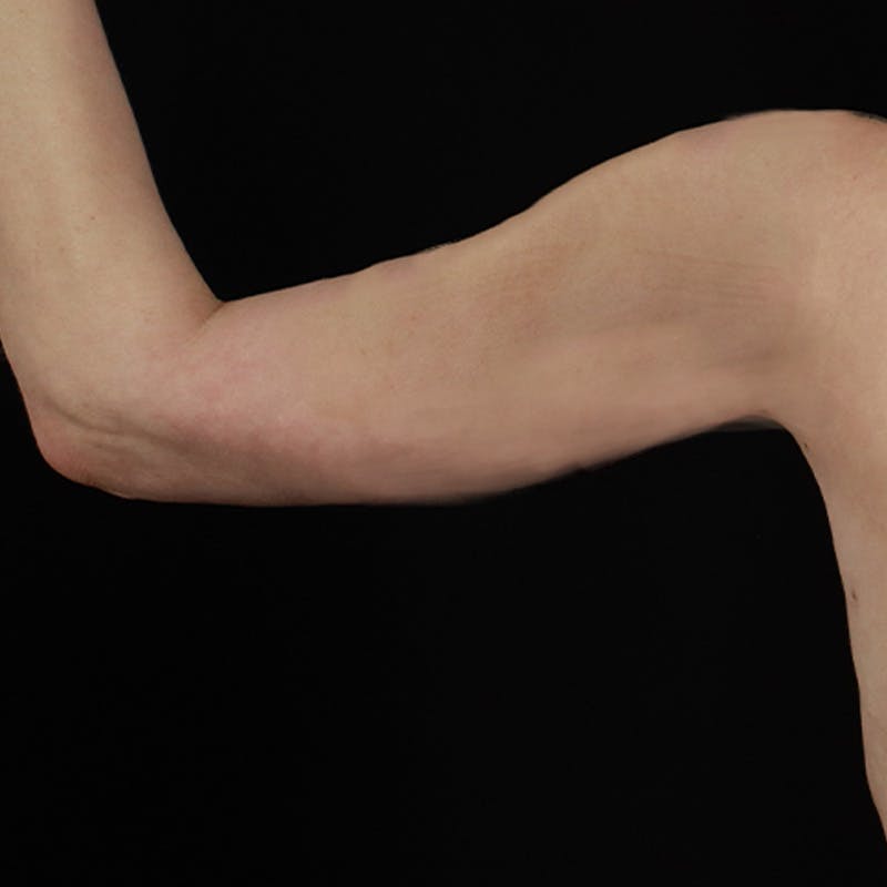 Arm Lift Before & After Gallery - Patient 101500 - Image 4