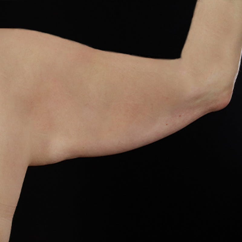 Arm Lift Before & After Gallery - Patient 101500 - Image 7