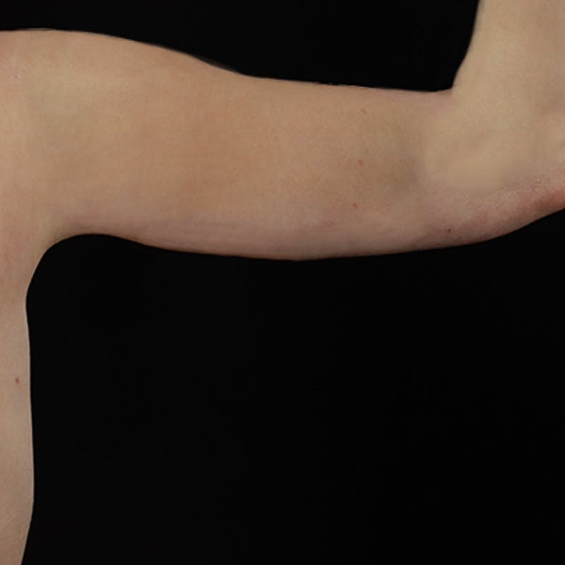Arm Lift Before & After Gallery - Patient 101500 - Image 8