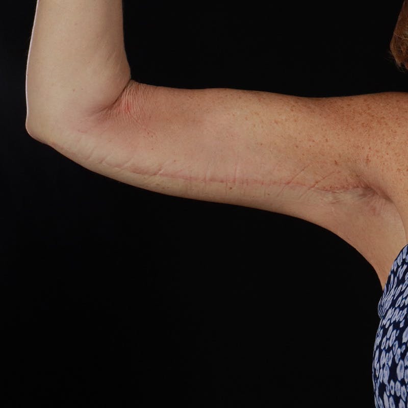 Arm Lift Before & After Gallery - Patient 114497 - Image 2