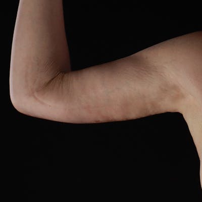Arm Lift Before & After Gallery - Patient 169013 - Image 2