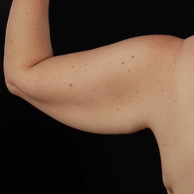 Arm Lift Before & After Gallery - Patient 405437 - Image 3