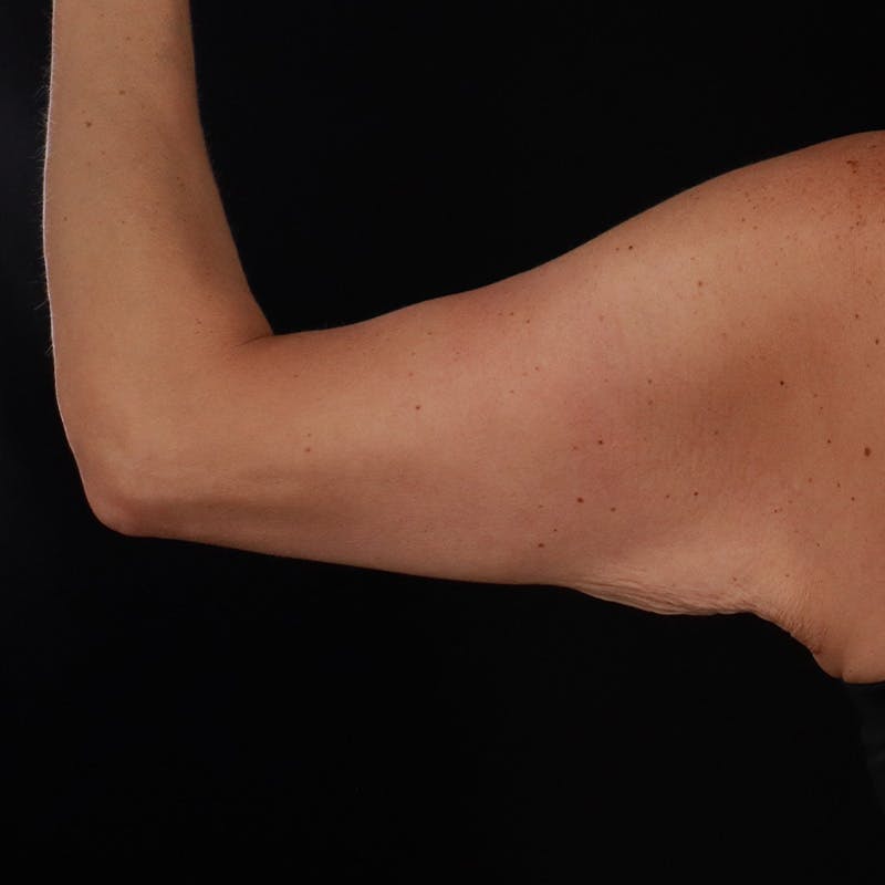 Arm Lift Before & After Gallery - Patient 169845 - Image 3
