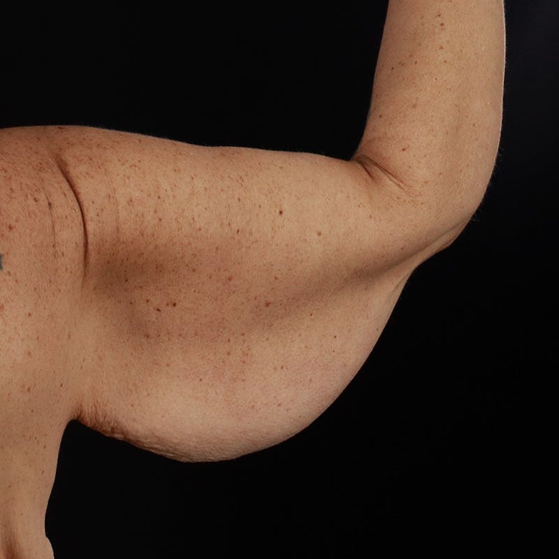Arm Lift Before & After Gallery - Patient 323909 - Image 7