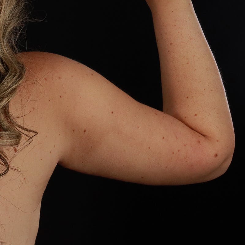 Arm Lift Before & After Gallery - Patient 405437 - Image 8