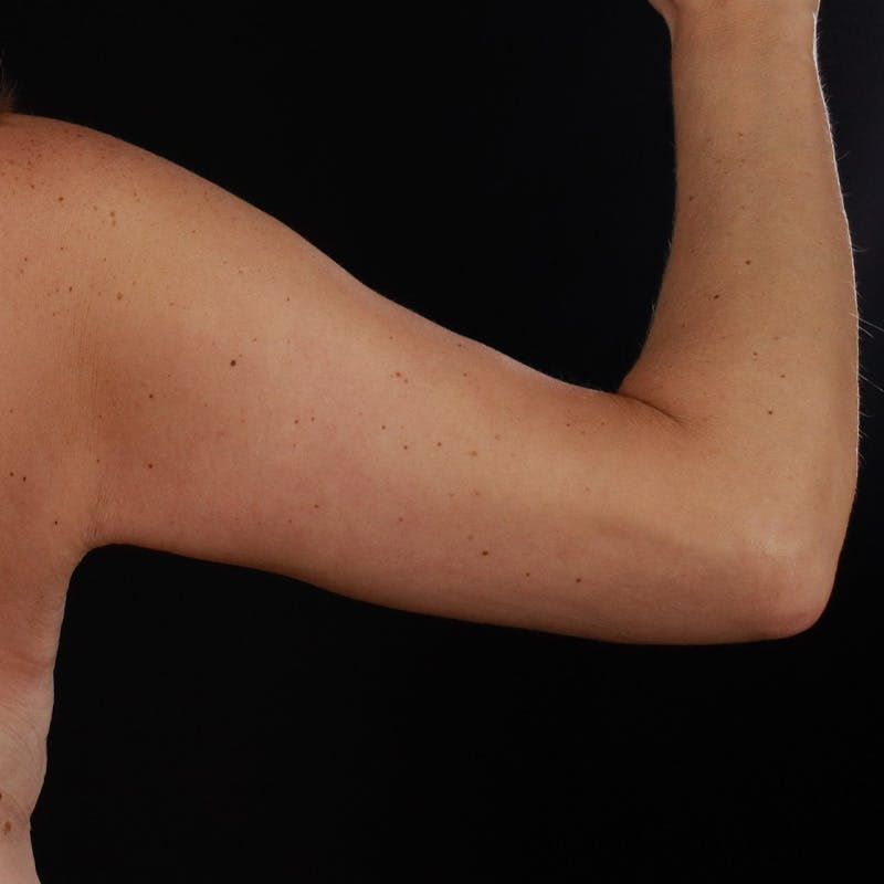 Arm Lift Before & After Gallery - Patient 169845 - Image 8