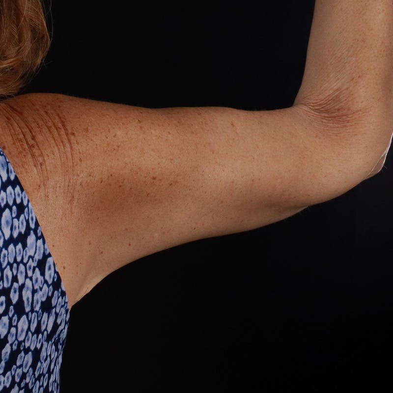 Arm Lift Before & After Gallery - Patient 114497 - Image 8