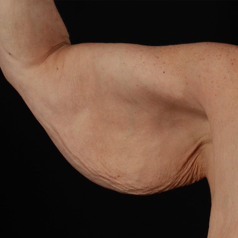 Arm Lift Before & After Gallery - Patient 323909 - Image 1