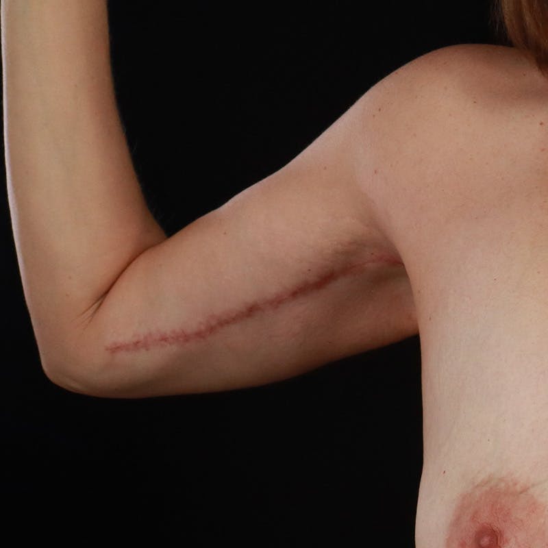 Arm Lift Before & After Gallery - Patient 169845 - Image 2