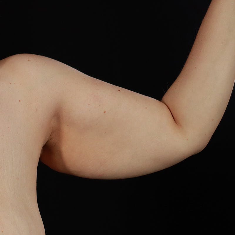 Arm Lift Before & After Gallery - Patient 405437 - Image 5