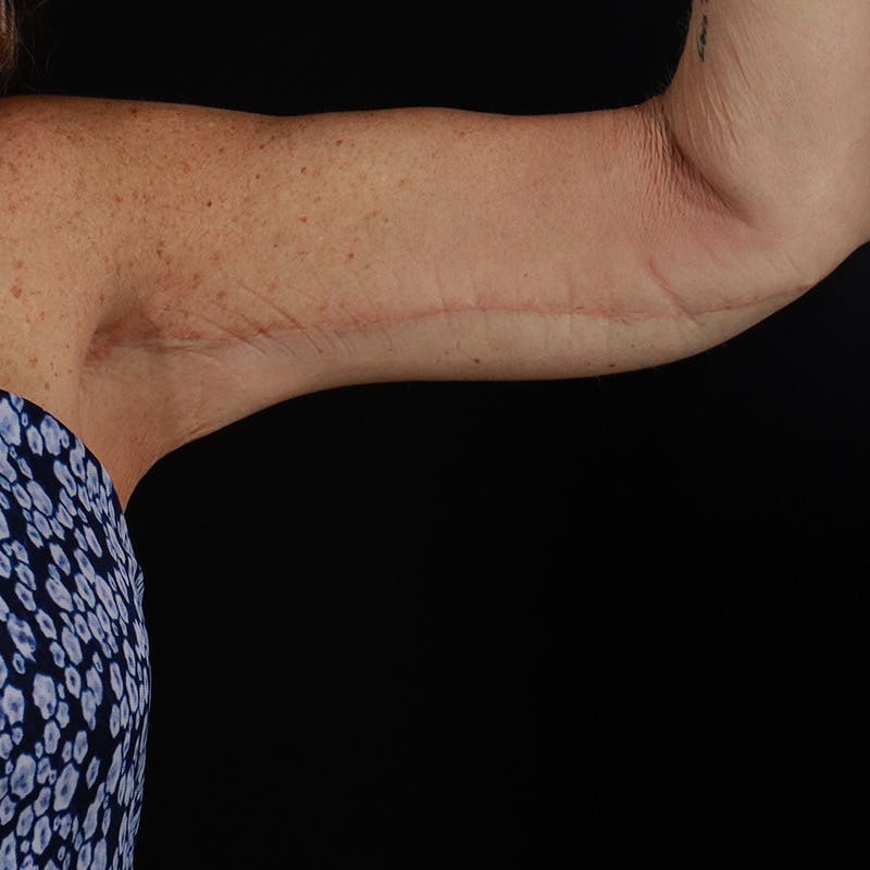 Arm Lift Before & After Gallery - Patient 114497 - Image 6