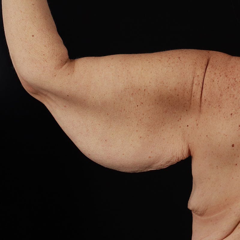 Arm Lift Before & After Gallery - Patient 323909 - Image 3